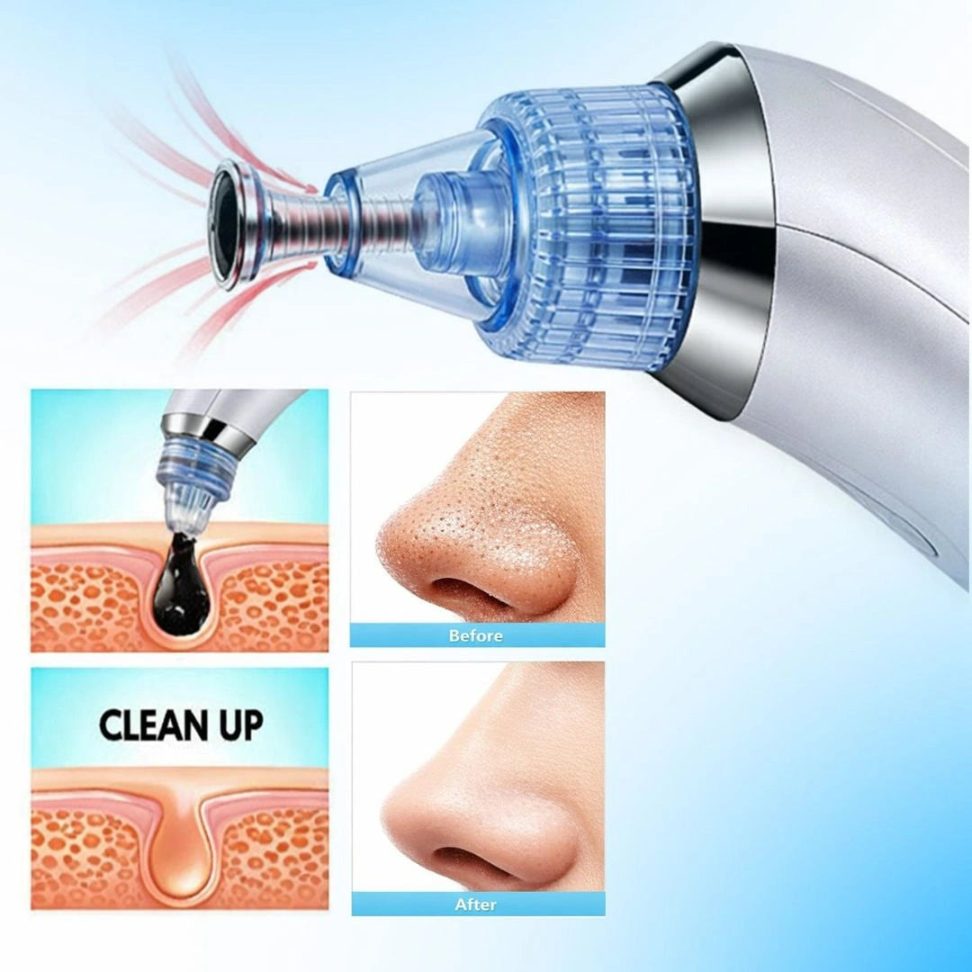 Blackhead Remover Vacuum Device with Suction Heads